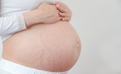 Rạn da khi mang thai là vấn đề mà rất nhiều chị em phụ nữ quan tâm