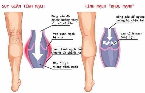 Sự khác biệt của suy giãn tĩnh mạch chân