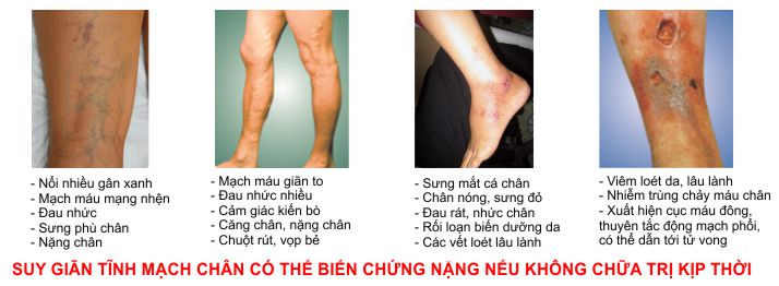 Các biến chứng của suy giãn tĩnh mạch chân