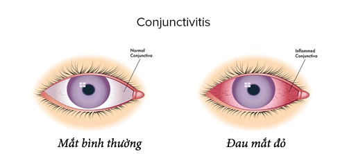 Đau mắt đỏ là căn bệnh rất phổ biến và thường gặp