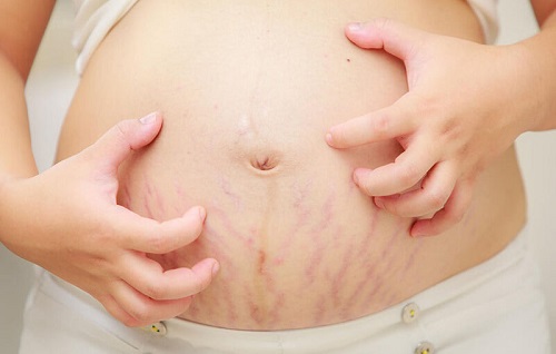 Rạn da là tình trạng rất phổ biến trong và sau khi sinh nở