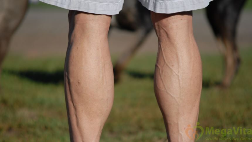 Giãn tĩnh mạch chân là một loại bệnh không thể xem thường