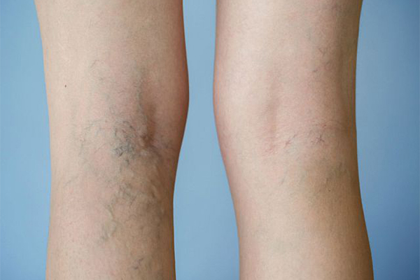 Giãn tĩnh mạch chân là căn bệnh phổ biến thường gặp ở phụ nữ và người cao tuổi 